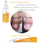 SET – zarůstající nehet (domácí péče) - Obrázek 2